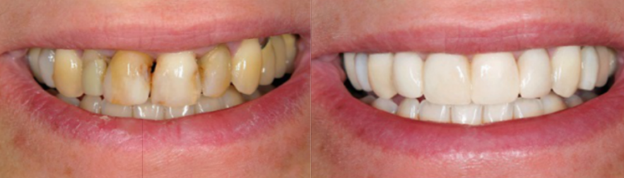 Carillas Dentales - Resultados excepcionales - Dental Piulachs